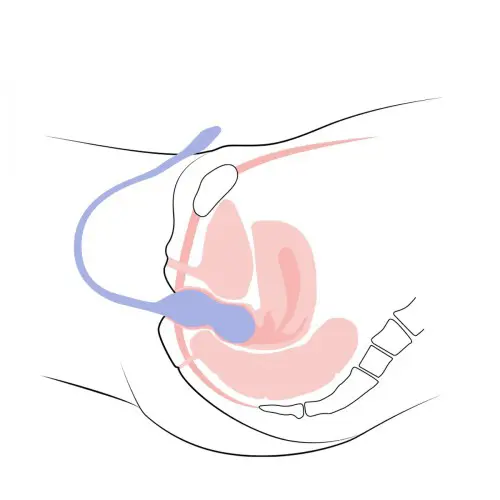 perifit-care-connected-perineal-probe.webp