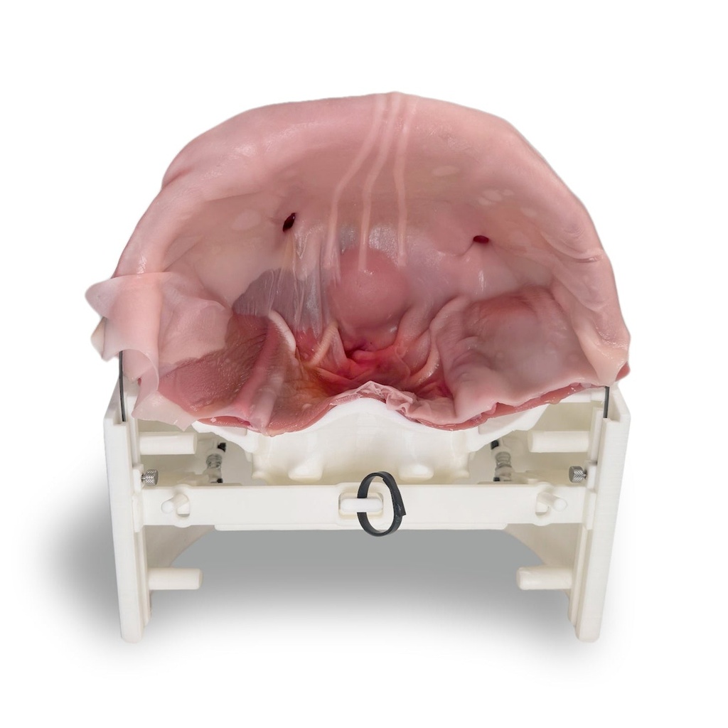 Inguinal Hernia (Class IV)