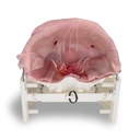 Inguinal Hernia (Class IV)