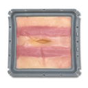 Ventral Hernia (Class II)