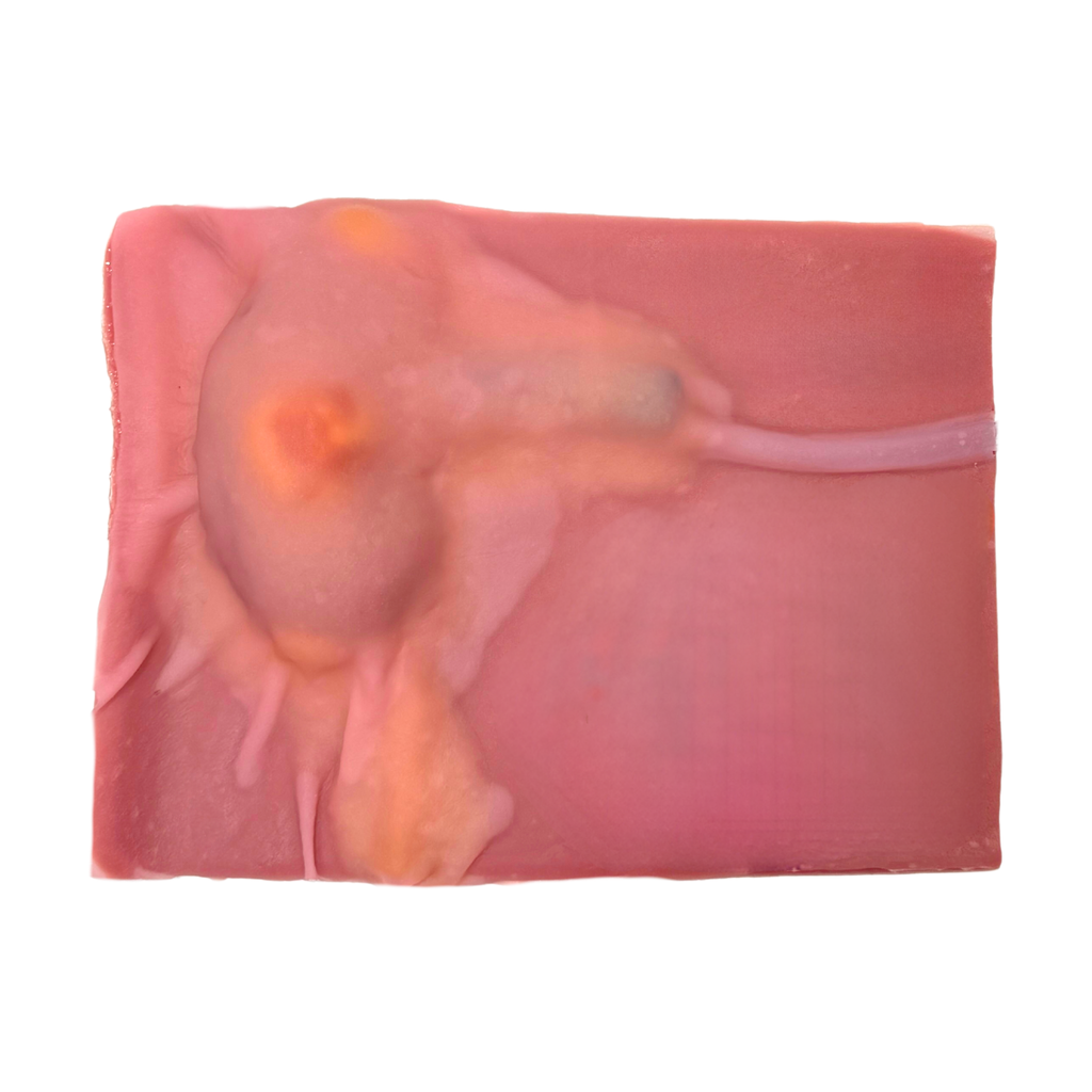Partial Nephrectomy (Class IV)