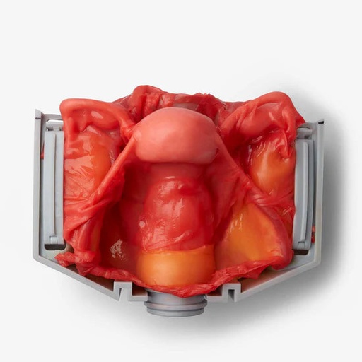 [GYNHYSIV] Hysterectomy (Class IV)